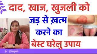 दाद, खाज, खुजली को जड़ से ख़त्म करने के घरेलु उपाय | daad khaj khujli ki dawa, dinay ka dawa