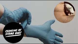 This is how I change my stoma bag.