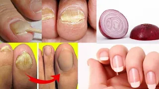Do you suffer from nail fungus?  You have to do this!!!!  *** VERY IMPORTANT TIP ***