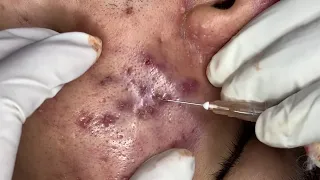 Deep Blackheads Removal from Cheeks and Nose | Best Pimple Popping Video #002 