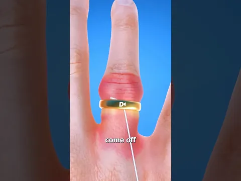 The Ring Stuck How Can I Remove It ?😳