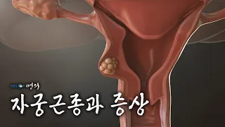 [명의 의학백과📖] 자궁근종과 증상