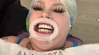 GETTING MY TEETH DONE IN MEXICO $2,500