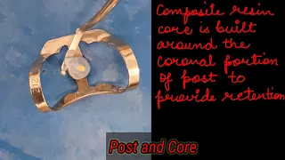 post and core procedure