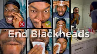 2 Weeks Since I Removed oil in my Nose (Things You shouldn’t do to be Safe) The End of  Blackheads