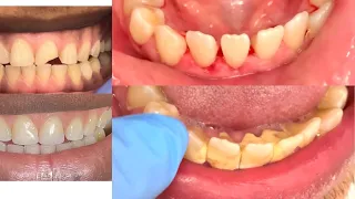 Dental Tartar , Huge chunks off