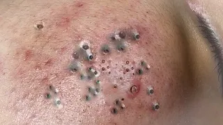 ニョキニョキ角栓/スポスポ角栓除去/𝐫𝐞𝐥𝐚𝐱/𝐒𝐚𝐭𝐢𝐬𝐟𝐲𝐢𝐧𝐠/𝐧𝐨𝐬𝐞 𝐛𝐥𝐚𝐜𝐤𝐡𝐞𝐚𝐝𝐬/𝐭𝐰𝐞𝐞𝐳𝐞𝐫𝐬/𝐚𝐜𝐧𝐞 𝐭𝐫𝐞𝐚𝐭𝐦𝐞𝐧𝐭/ピンセット/피지제거𝐍𝐨.34