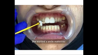Smile design with porcelain bridges and #porcelainveneers