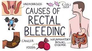 Understanding the Causes of Blood in Stool (Rectal Bleeding)
