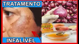 👉🏽MELASMA TRATAMENTO INFALÍVEL com CEBOLA ROXA e VINAGRE DE MAÇÃ