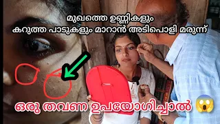 മുഖത്തെ ഉണ്ണികളും കറുത്ത പാടുകളും മാറാൻ ആയുർവേദ മരുന്ന്/#vlog#SVThalasserycouple