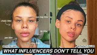 Why I STOPPED getting FILLER and YOU maybe should too