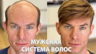 Алопеция у мужчин. Накладка из волос. До и после