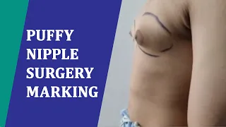 🔴Live 🔴 Puffy Nipple surgery Marking