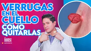VERRUGAS EN EL CUELLO, COMO QUITARLAS. Tips de un dermatologo