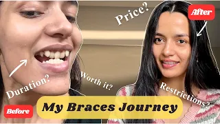Everything You Need To Know About BRACES 🦷 | Cost? | Duration | Restrictions? ❓