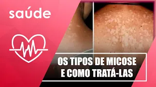Descubra quais são os tipos de micose e como tratá-las com dr. Werick França – 01/02/22