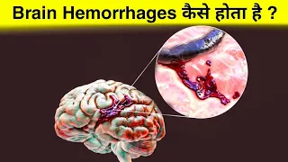 ब्रेन हेमरेज क्या है ? ये कैसे होता हैं ? पूरा मेडिकल सच होश उड़ा देगा! how brain hemorrhage occurs ?