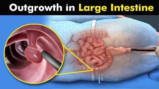 Colon Polypectomy | Removal Of Polyps From Large intestine (Urdu/Hindi)