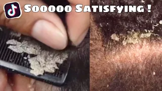 DANDRUFF SCRATCHING COMPILATION |  Dry Itchy Scalp | Huge Flakes 🔇