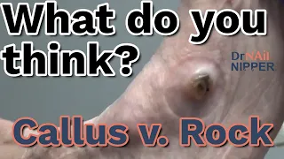 Callus or Rock?  Ankle Foot Orthosis Support.  Callus Tuesday (on a Wednesday) - Is Back? (2022)