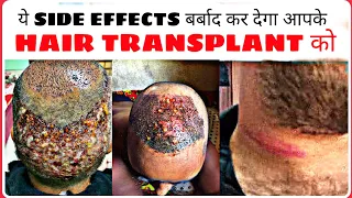 मत कराना HAIR TRANSPLANT 😱 इस VIDEO को देखे बिना || LATEST SIDE EFFECTS OF HAIR TRANSPLANT