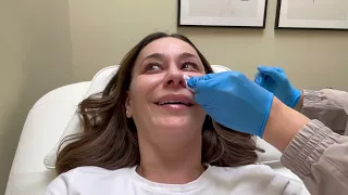 Got Sculptra, Morpheus 8 & PRP Injections: Here's My Review!