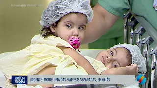 Morre uma das siamesas separadas em Goiás