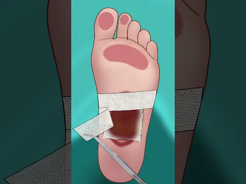 ASMR Treatment foot p2 #asmr #animation #shorts
