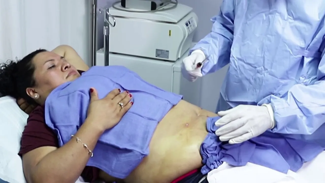 Autologous Fat Transfer Session video