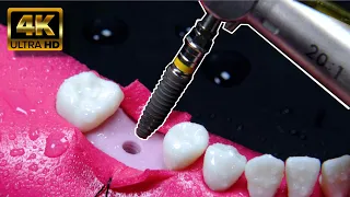 IMPRESIONANTE proceso del implante dental en 4K