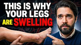The Real Vitamin for Varicose Veins (Not Vitamin C)