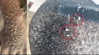 DANDRUFF SCRATCHING | Dry Itchy Scalp | Huge Flakes 🔇 Part 3