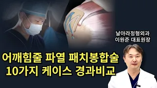 어깨 회전근개파열 패치봉합술 수술전후 실제 10가지 케이스 경과 비교분석