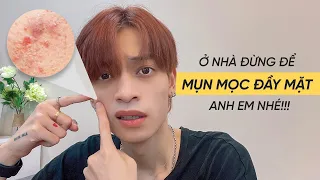 Share & Shine - Ở Nhà Đừng Để Mụn Mọc Đầy Mặt Nhé Các Anh Em - Mẹo sạch mụn Nam