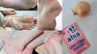كيحشموك رجليك مشقوقين ولونهم أسمر اليوم جبت ليك الحل اللي غادي ترحميني عليه علاج تشققات القدمين....