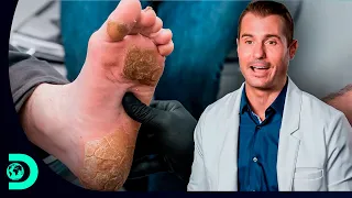 Doutor Brad: "nunca vi calos profundos tão grandes" | Meus Pés Estão Me Matando | Discovery Brasil