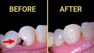 Trám sâu chân răng | Cavity front tooth