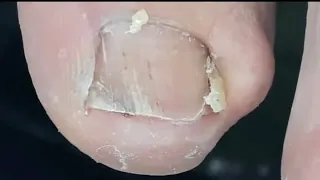 ELA ACHOU QUE ERA UM Pequeno Pedaço de Unha mas Quando Puxou Essa Era A Surpresa 😷 Podologa Nagel