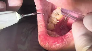 Double Scaling teeth 