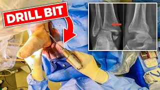 INSIDE THE OR: Ankle Fracture Open Reduction Internal Fixation (Surgical Video)