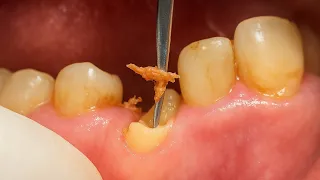 Build-Up of Canine Tooth with Fiber Post and Composite After Root Canal Treatment | Dental Case