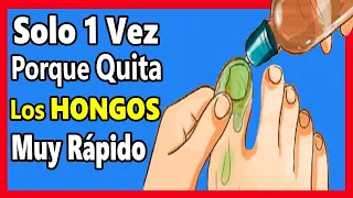 Echa este ACEITE 1 vez en tus PIES con HONGOS💅 Adiós HONGOS de las UÑAS en 2 días