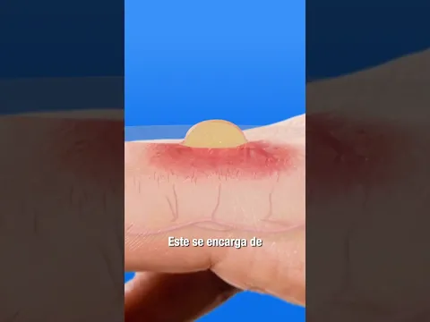 ¿Deberías tronar una ampolla? 🤔