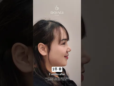 Concerned About a Blunt Nose?