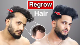 How To Regrow Hair Naturally for Men|बालों को मोटा और घना कैसे करे|pawan yudi khatri