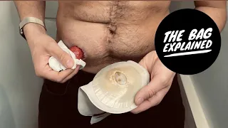 What is a stoma bag and why do I have one?