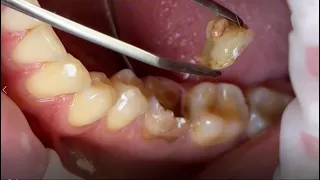 Doctor Peter Pulled Out the Broken Tooth