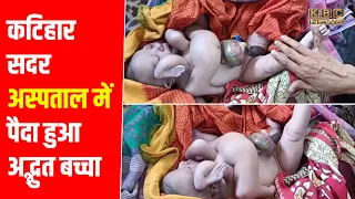 कटिहार सदर अस्पताल में पैदा हुआ अद्भुत बच्चा..