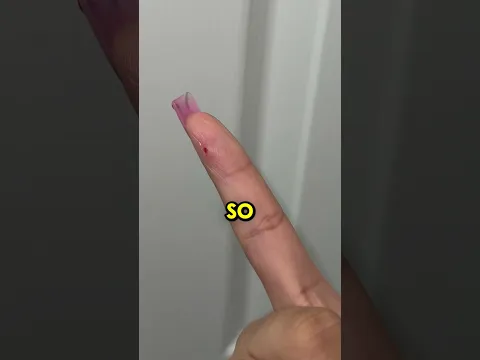Glass Stuck In Finger For 3 Years 🤯